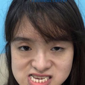 Hình ảnh phẫu thuật hàm - Viện Thẩm mỹ Hùng Vương – Ca 11