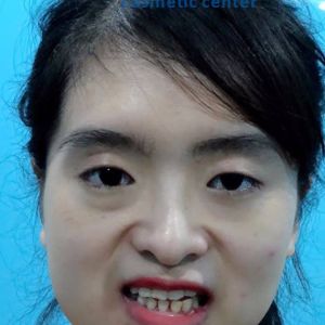 Hình ảnh phẫu thuật hàm - Viện Thẩm mỹ Hùng Vương – Ca 11