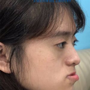 Hình ảnh phẫu thuật hàm - Viện Thẩm mỹ Hùng Vương – Ca 11