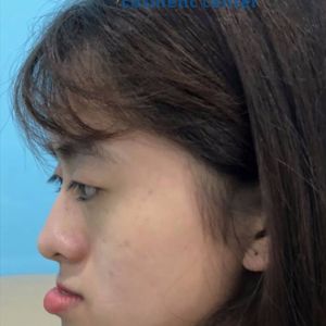 Hình ảnh phẫu thuật hàm - Viện Thẩm mỹ Hùng Vương – Ca 11