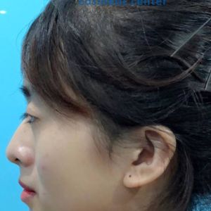 Hình ảnh phẫu thuật hàm - Viện Thẩm mỹ Hùng Vương – Ca 11