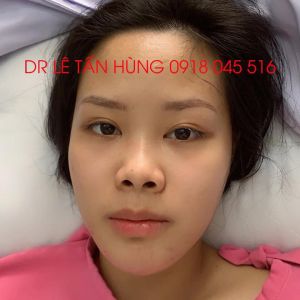 Hình ảnh phẫu thuật hàm của KH Trương Thu Hương – Viện Thẩm mỹ Hùng Vương – Ca 3