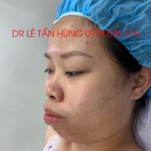 Hình ảnh phẫu thuật hàm của KH Trương Thu Hương – Viện Thẩm mỹ Hùng Vương – Ca 3
