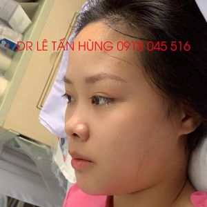 Hình ảnh phẫu thuật hàm của KH Trương Thu Hương – Viện Thẩm mỹ Hùng Vương – Ca 3