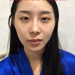 Hình ảnh phẫu thuật hàm và hạ gò má của KH Li Chiao Yin – Viện Thẩm mỹ Hùng Vương – Ca 4