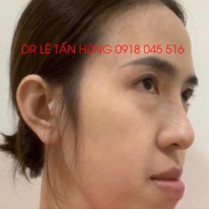 Hình ảnh phẫu thuật hàm của KH Kim Ngân – Viện Thẩm mỹ Hùng Vương – Ca 5