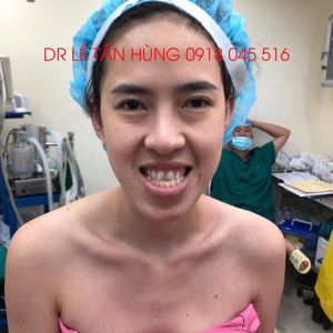 Hình ảnh phẫu thuật hàm của KH Kim Ngân – Viện Thẩm mỹ Hùng Vương – Ca 5