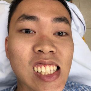 Hình ảnh phẫu thuật hàm của KH Nguyễn Văn Hải – Viện Thẩm mỹ Hùng Vương – Ca 6