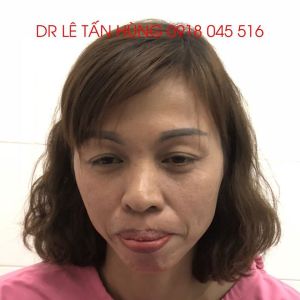 Hình ảnh phẫu thuật hàm của KH Nguyễn Thị Hạnh – Viện Thẩm mỹ Hùng Vương – Ca 7