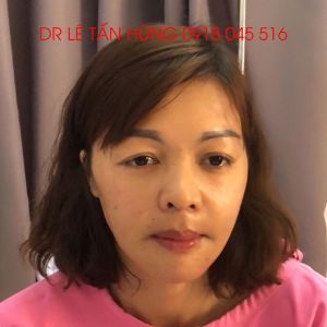 Hình ảnh phẫu thuật hàm của KH Nguyễn Thị Hạnh – Viện Thẩm mỹ Hùng Vương – Ca 7