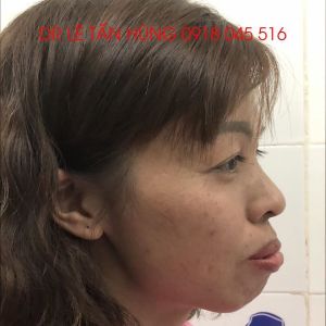 Hình ảnh phẫu thuật hàm của KH Nguyễn Thị Hạnh – Viện Thẩm mỹ Hùng Vương – Ca 7