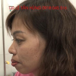 Hình ảnh phẫu thuật hàm của KH Nguyễn Thị Hạnh – Viện Thẩm mỹ Hùng Vương – Ca 7