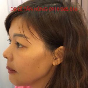 Hình ảnh phẫu thuật hàm của KH Nguyễn Thị Hạnh – Viện Thẩm mỹ Hùng Vương – Ca 7