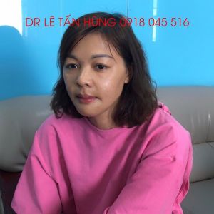 Hình ảnh phẫu thuật hàm của KH Nguyễn Thị Hạnh – Viện Thẩm mỹ Hùng Vương – Ca 7