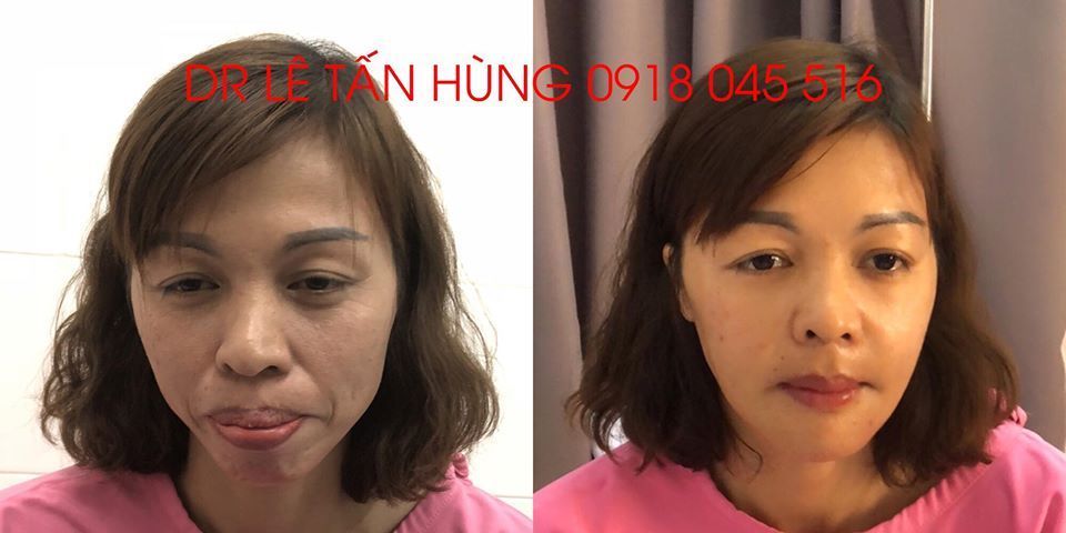 Hình ảnh phẫu thuật hàm của KH Nguyễn Thị Hạnh – Viện Thẩm mỹ Hùng Vương – Ca 7