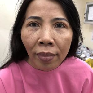 Hình ảnh phẫu thuật hàm và hạ gò má – Viện Thẩm mỹ Hùng Vương – Ca 8