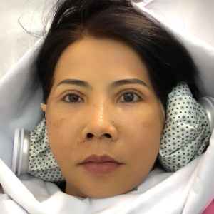 Hình ảnh phẫu thuật hàm và hạ gò má – Viện Thẩm mỹ Hùng Vương – Ca 8