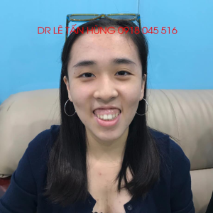 Hình ảnh phẫu thuật hàm của KH Chian Ting Huang – Viện Thẩm mỹ Hùng Vương – Ca 1