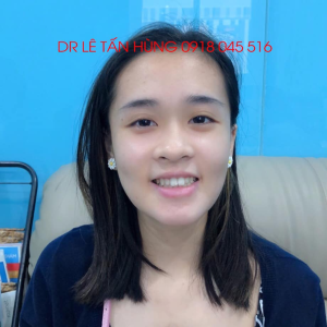 Hình ảnh phẫu thuật hàm của KH Chian Ting Huang – Viện Thẩm mỹ Hùng Vương – Ca 1