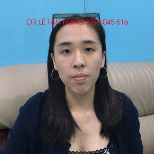 Hình ảnh phẫu thuật hàm của KH Chian Ting Huang – Viện Thẩm mỹ Hùng Vương – Ca 1