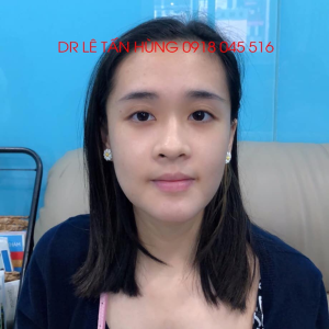 Hình ảnh phẫu thuật hàm của KH Chian Ting Huang – Viện Thẩm mỹ Hùng Vương – Ca 1