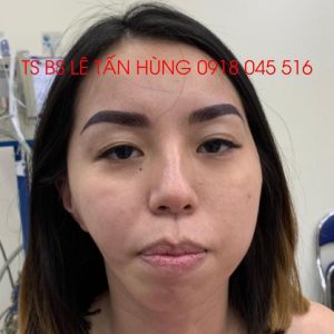 Hình ảnh phẫu thuật hàm của KH Đặng Thị - Viện Thẩm mỹ Hùng Vương – Ca 2