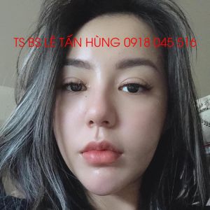 Hình ảnh phẫu thuật hàm của KH Đặng Thị - Viện Thẩm mỹ Hùng Vương – Ca 2