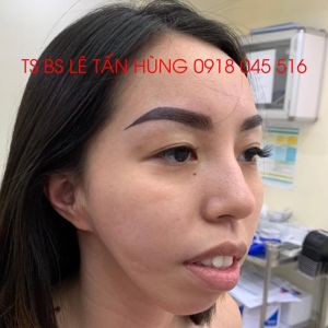 Hình ảnh phẫu thuật hàm của KH Đặng Thị - Viện Thẩm mỹ Hùng Vương – Ca 2