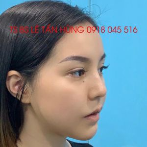 Hình ảnh phẫu thuật hàm của KH Đặng Thị - Viện Thẩm mỹ Hùng Vương – Ca 2