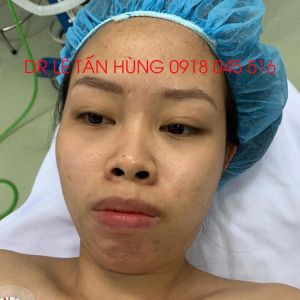 Hình ảnh phẫu thuật hàm của KH Trương Thu Hương – Viện Thẩm mỹ Hùng Vương – Ca 3