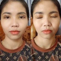 Cắt mí không đều