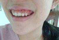 Nên phẫu thuật hàm hay chỉ cắt lợi