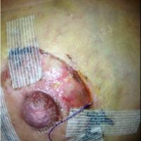 Nhiễm trùng quầng vú sau treo ngực sa trễ? Nhiễm trùng quầng vú sau treo ngực sa trễ?