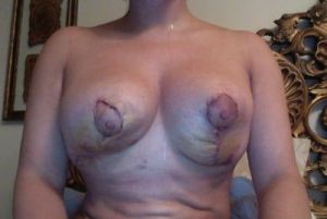 Ngực biến dạng sau treo ngực sa trễ không đặt túi độn 11 ngày?