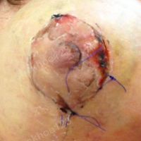 Nhiễm trùng quầng vú sau treo ngực sa trễ?