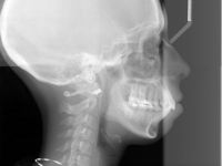 Nên phẫu thuật hàm hay niềng răng cho trường hợp hô vẩu, cười hở lợi