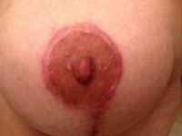 Sẹo phì đại sau treo ngực sa trễ Sẹo phì đại sau treo ngực sa trễ