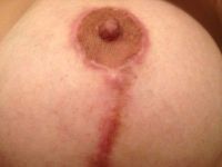 Sẹo phì đại sau treo ngực sa trễ