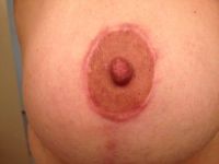 Sẹo phì đại sau treo ngực sa trễ