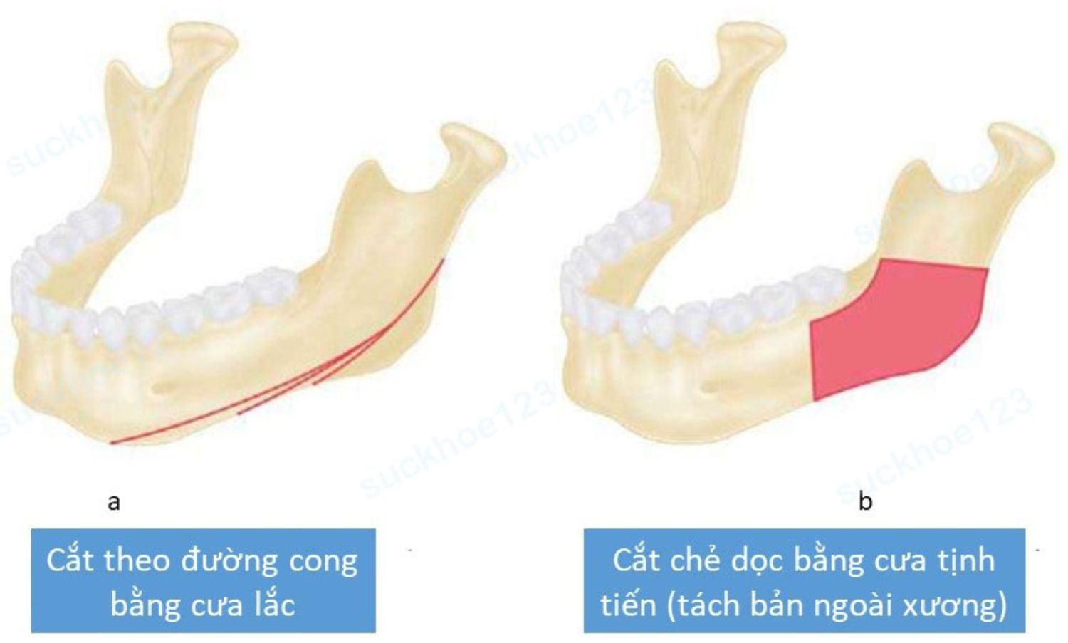 thu gọn góc hàm2