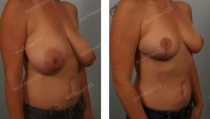 Thu nhỏ ngực phì đại khách hàng nữ 36 tuổi - ca 1