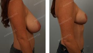 Thu nhỏ ngực phì đại khách hàng nữ 36 tuổi - ca 1