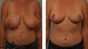 Thu nhỏ ngực phì đại khách hàng nữ 36 tuổi - ca 1