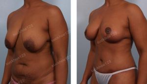 Thu nhỏ ngực phì đại và tạo hình thành bụng, nữ 40 tuổi - ca 10