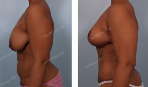 Thu nhỏ ngực phì đại và tạo hình thành bụng, nữ 40 tuổi - ca 10