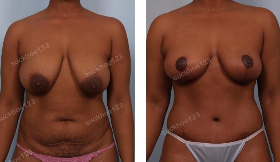 Thu nhỏ ngực phì đại và tạo hình thành bụng, nữ 40 tuổi - ca 10