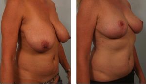 Thu nhỏ ngực phì đại, nữ ngoài 40 tuổi - ca 11