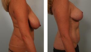 Thu nhỏ ngực phì đại, nữ ngoài 40 tuổi - ca 11