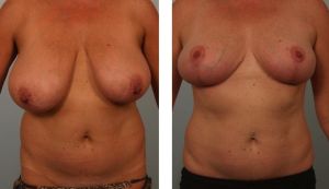 Thu nhỏ ngực phì đại, nữ ngoài 40 tuổi - ca 11