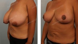 Thu nhỏ bộ ngực khổng lồ, nữ 31 tuổi - ca 12